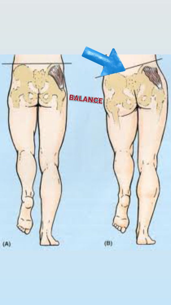 Medical illustration showing muscle atrophy on one hip and thigh, with a blue arrow pointing to the affected area.